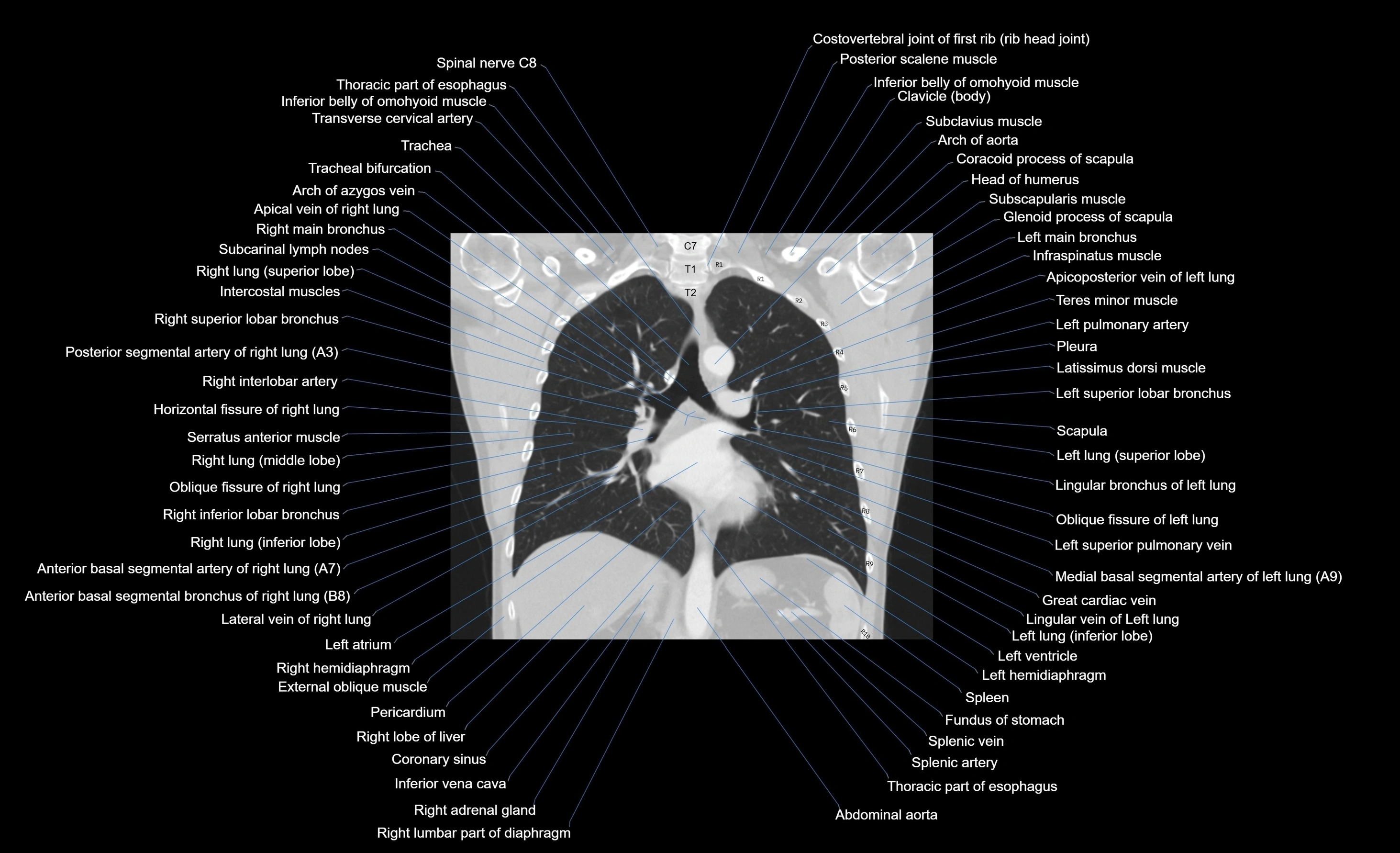 CT chest (thorax) lung window window labelled coronal cross sectional anatomy radiology image-00056.webp